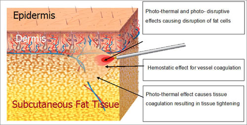 Effects of Laser Lipo in Los Angeles & Beverly Hills CA